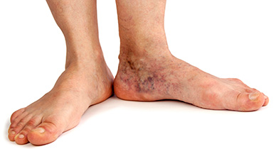 Foot & Leg Ulcers - Natural Skin Care Treatments | Aidance
