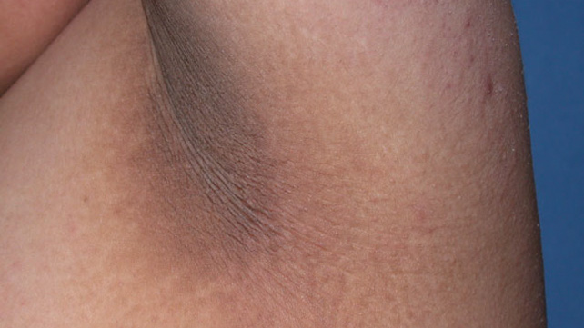 acanthosis nigrican treatment