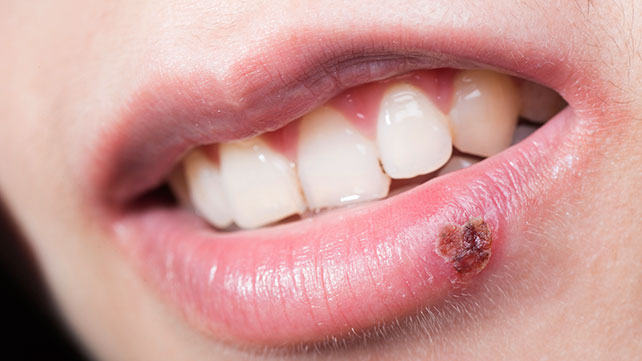 cold sore images