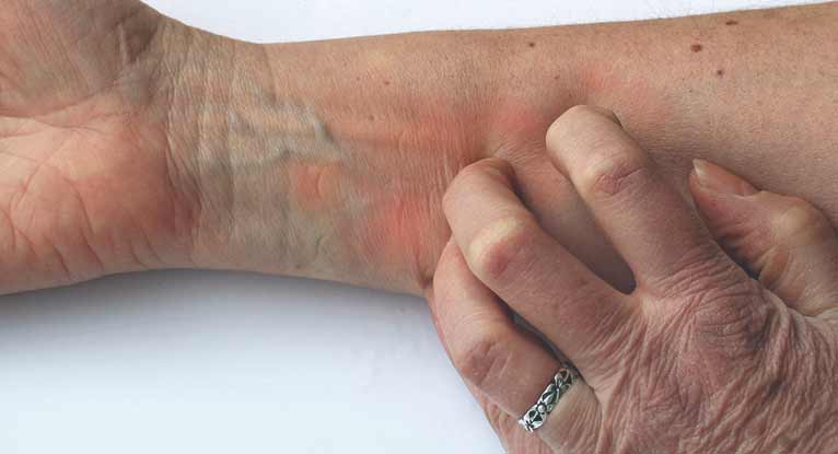 What are the symptoms of shingles on the hands?