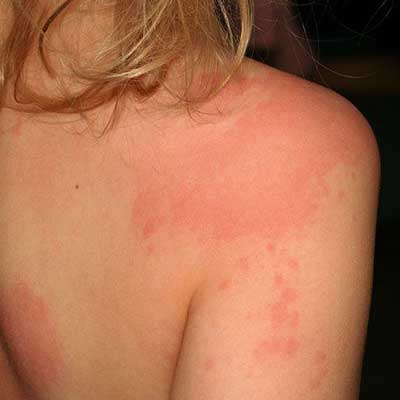 Steroid treatment for severe allergic reaction