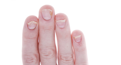 What is onycholysis or nail lifting? - Sharecare