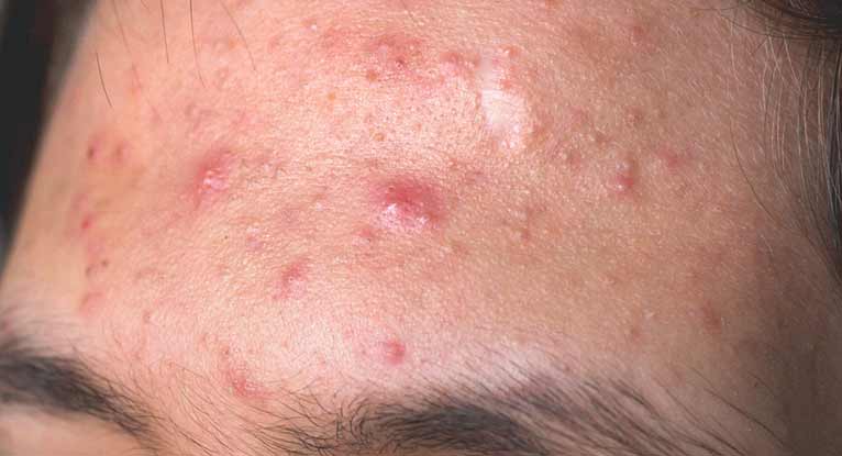 How long do pimples last?