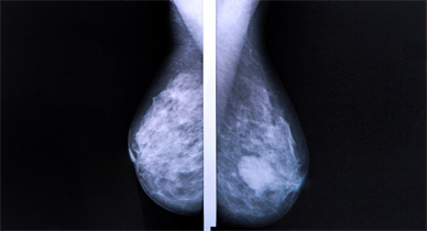 Is breast cancer fatal?