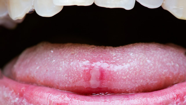 What causes a swollen tongue on one side?