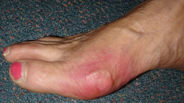 Pictures Of Gout 104