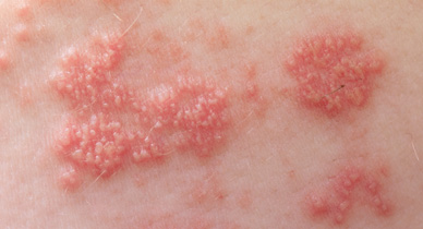 Can you have internal shingles with no rash?