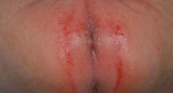 Causes of Anal rash - RightDiagnosis.com