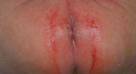 bumpy skin rash