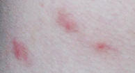 Flea Bites : Symptoms and Treatments - Health Line