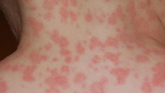 rashes from antibiotics
