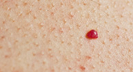 red raised bumps on skin, Search.com