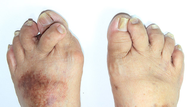 How do you treat arthritis in toes?