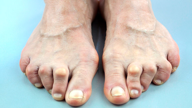 How do you treat arthritis in toes?