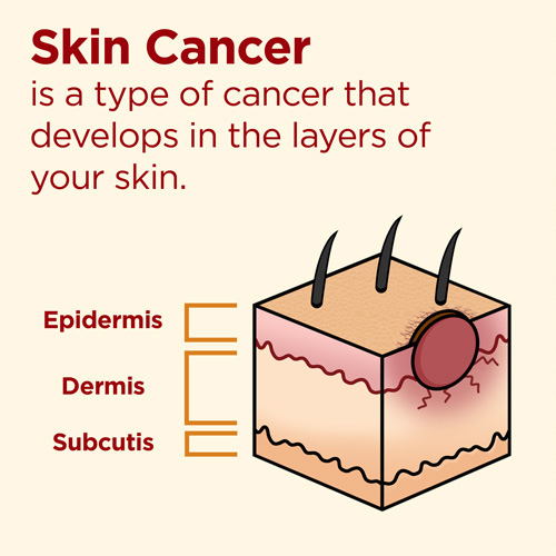 How can you reduce your chances of getting skin cancer?