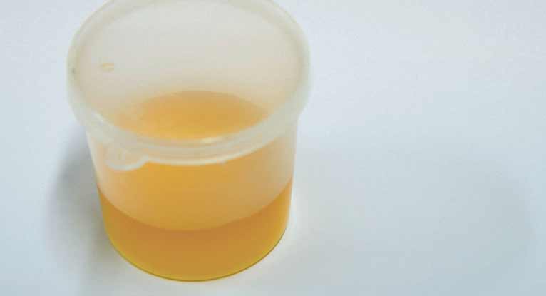 Leukocytes in Urine: What You Should Know