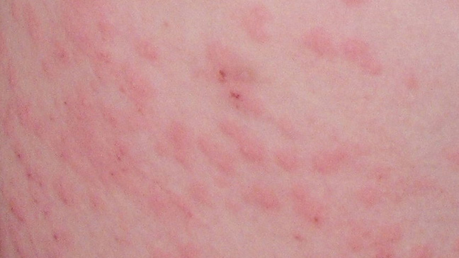 can clopidogrel cause skin rash