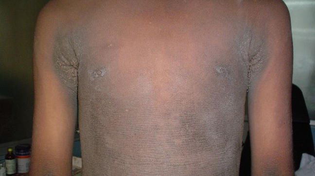Acanthosis Nigricans: Treatment, Pictures, and Causes