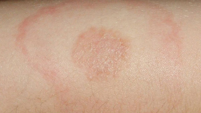 Erythema Migrans: Identification, Treatment, and More