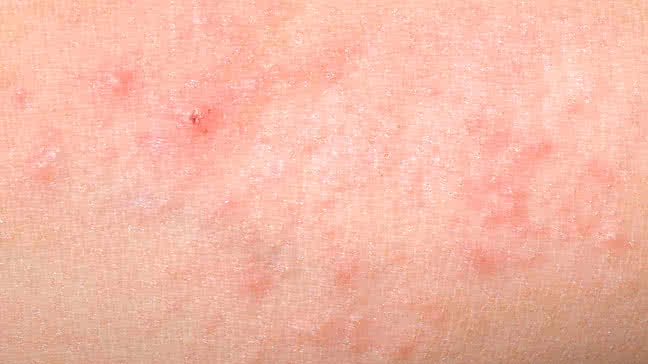 Heat Rash Pictures Remedies And More