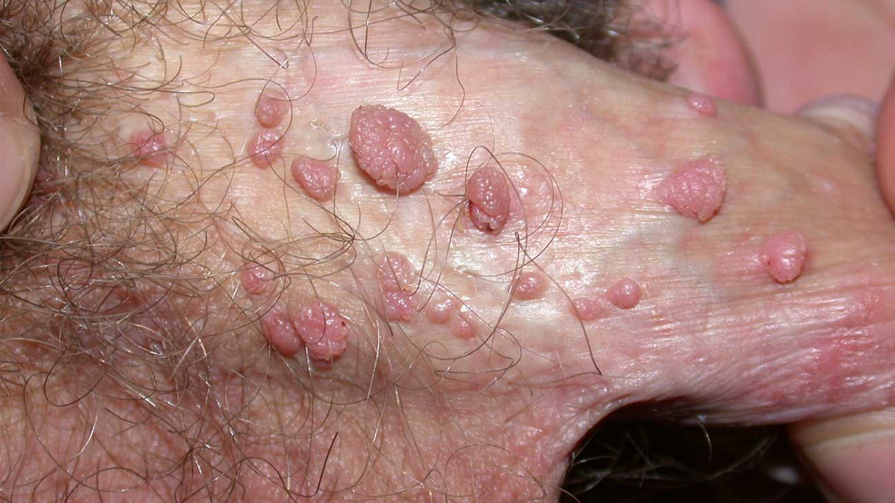 Image result for std penis
