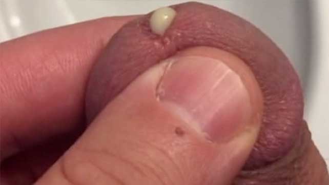 Swelling Of Penis 75