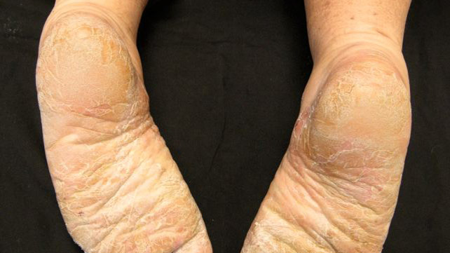 Plantar And Palmar Psoriasis Treatment And More