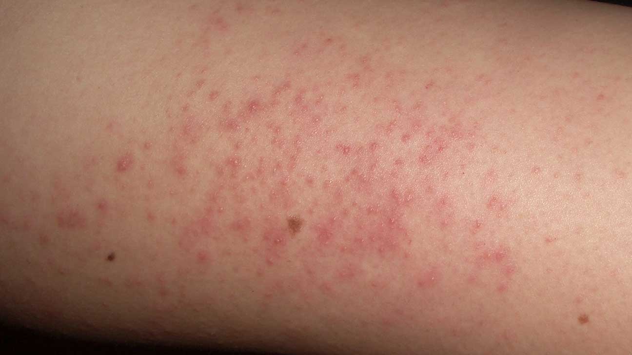 Red Round Dry Patch On Leg Goomoves