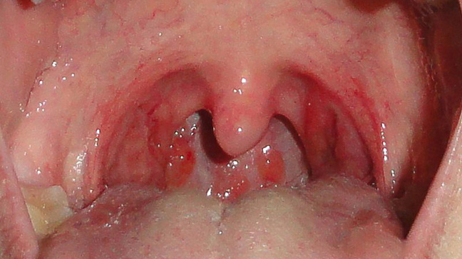 Virus Throat 22