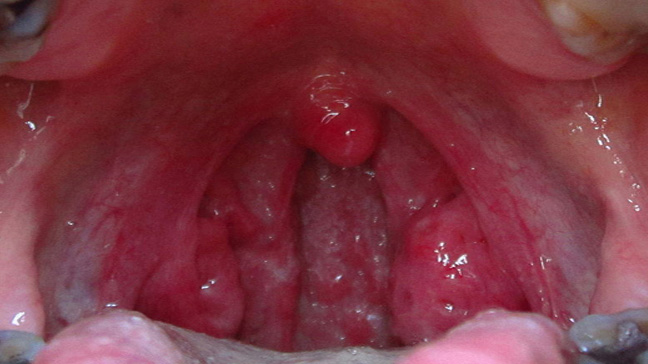 Cause Of Soar Throat 24
