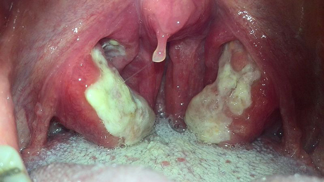 Picture Of A Throat 49
