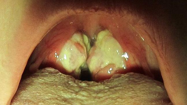 Pictures Of Strep Throat Bacteria 21