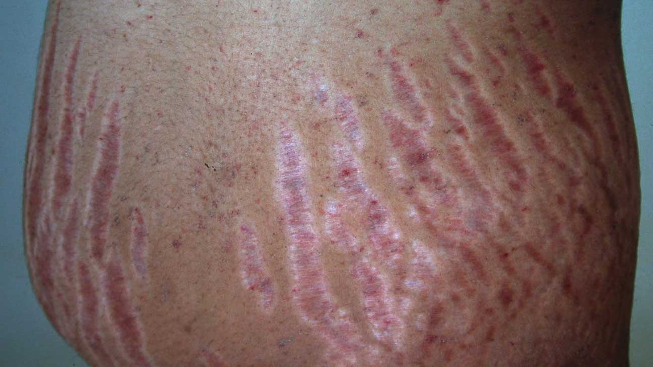 Stretch Marks Causes Diagnosis And Treatments