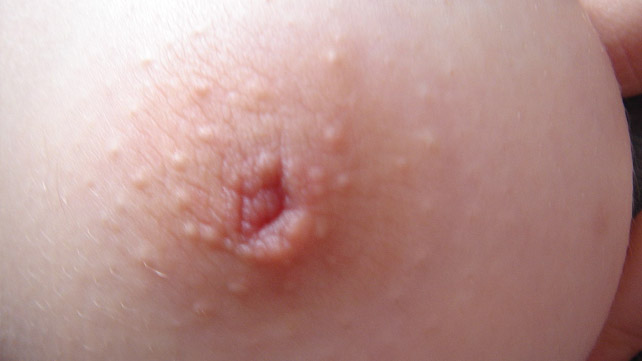 White Spots On My Nipples 51