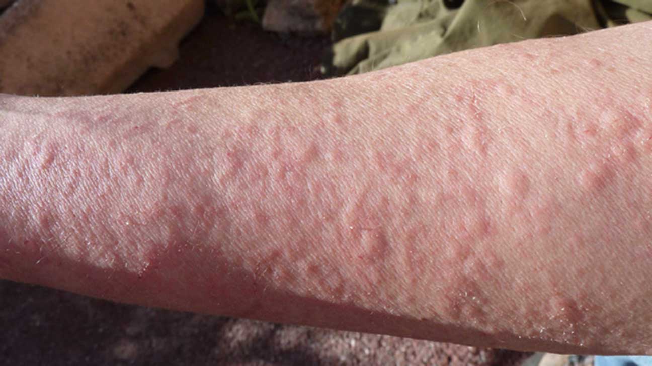 skin rashes that itch all over body