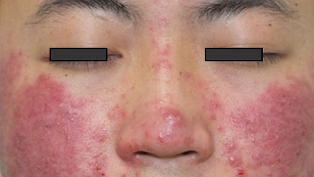 web doctors: Are Mites Causing Your Rosacea?