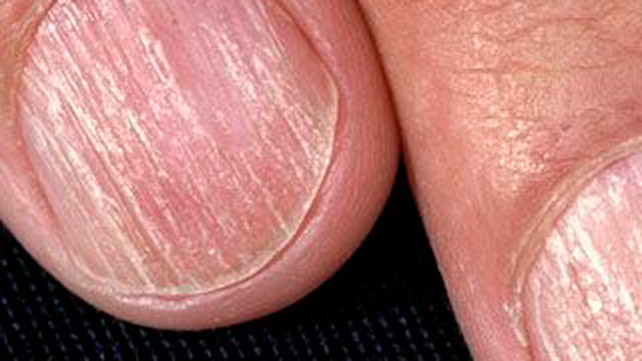 Ridges In Fingernails Symptoms Causes And Treatments