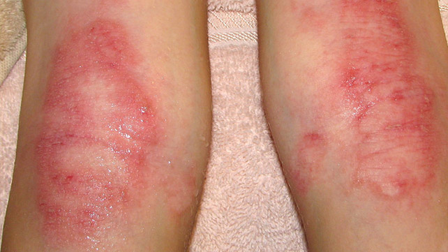 Eczema Nummular Eczema Vs Ringworm Pictures