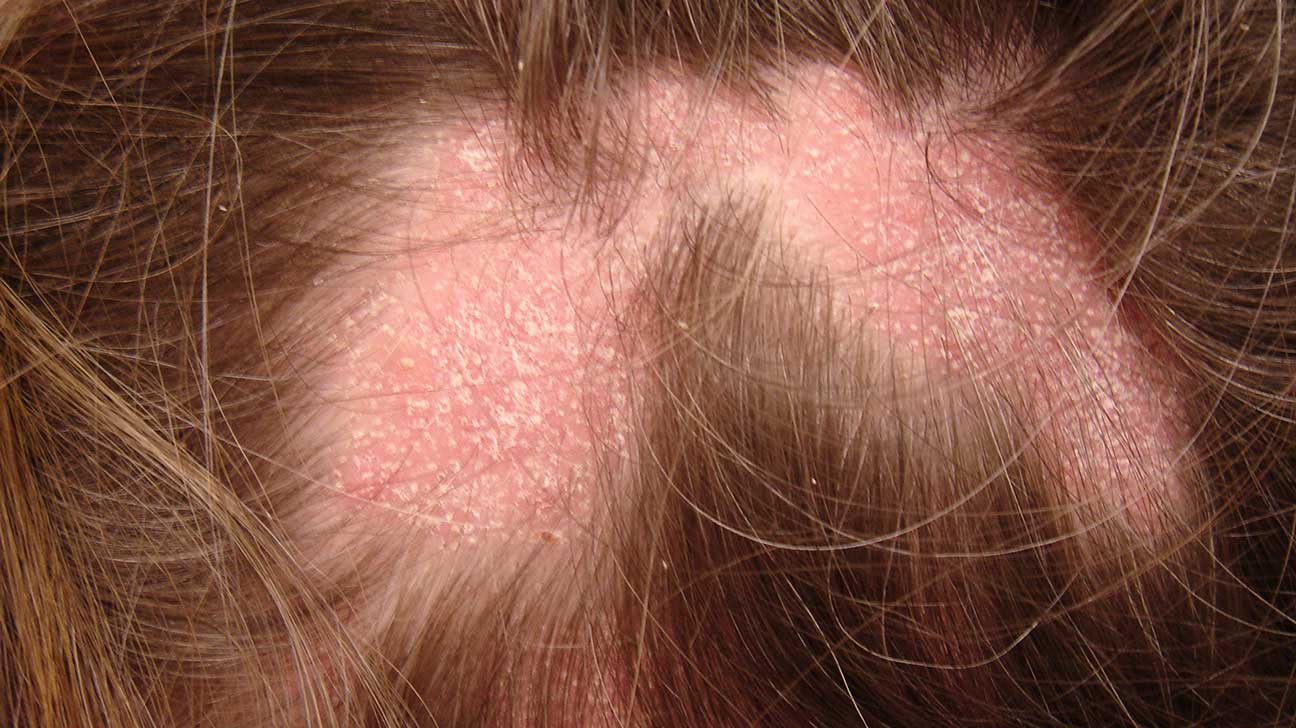 Sample Can Stress Cause Sores On Your Scalp for Thick Hair