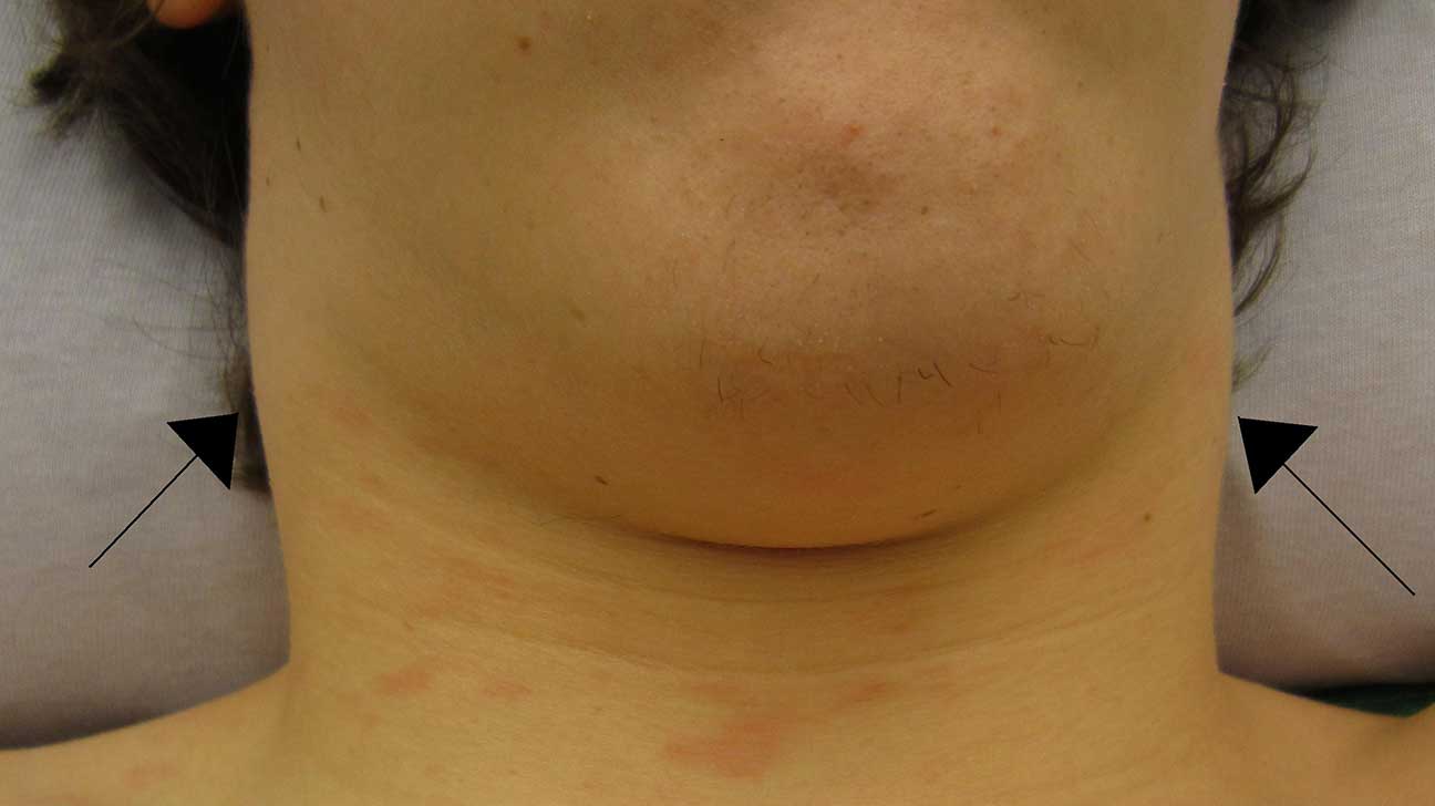 swollen neck lymph nodes