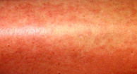 Hives: Causes, Risks, Prevention, and Pictures