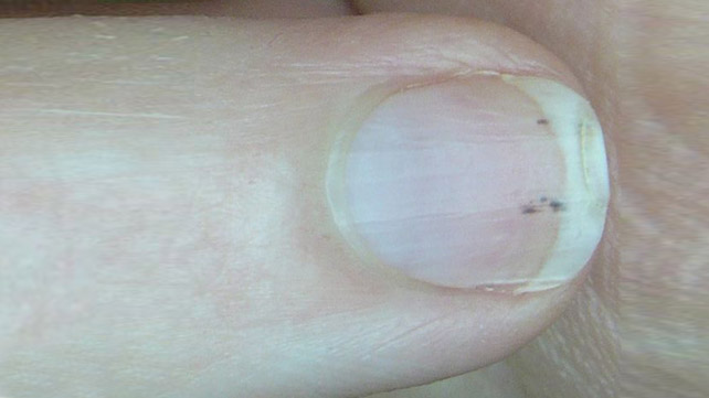 Black Line on the Nail: Causes, Treatments, Pictures and More