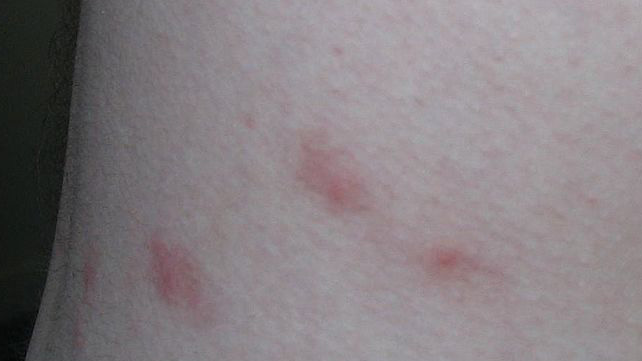 Image result for flea bites in people