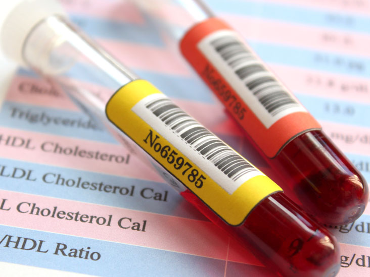 Cholesterol Test Results Chart