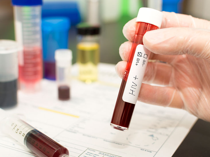 ELISA, Western Blot, e altri test per l'HIV