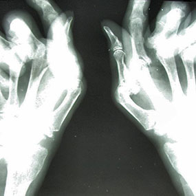 8 Pictures of Rheumatoid Arthritis Symptoms