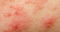 Allergic Eczema