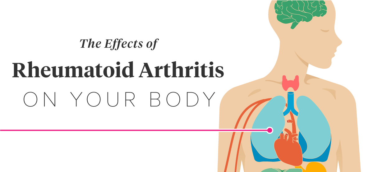 Rheumatoid Arthritis and Its Effects on Todays