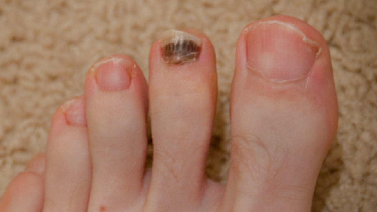 dis colored bumpy spot on big toe nail