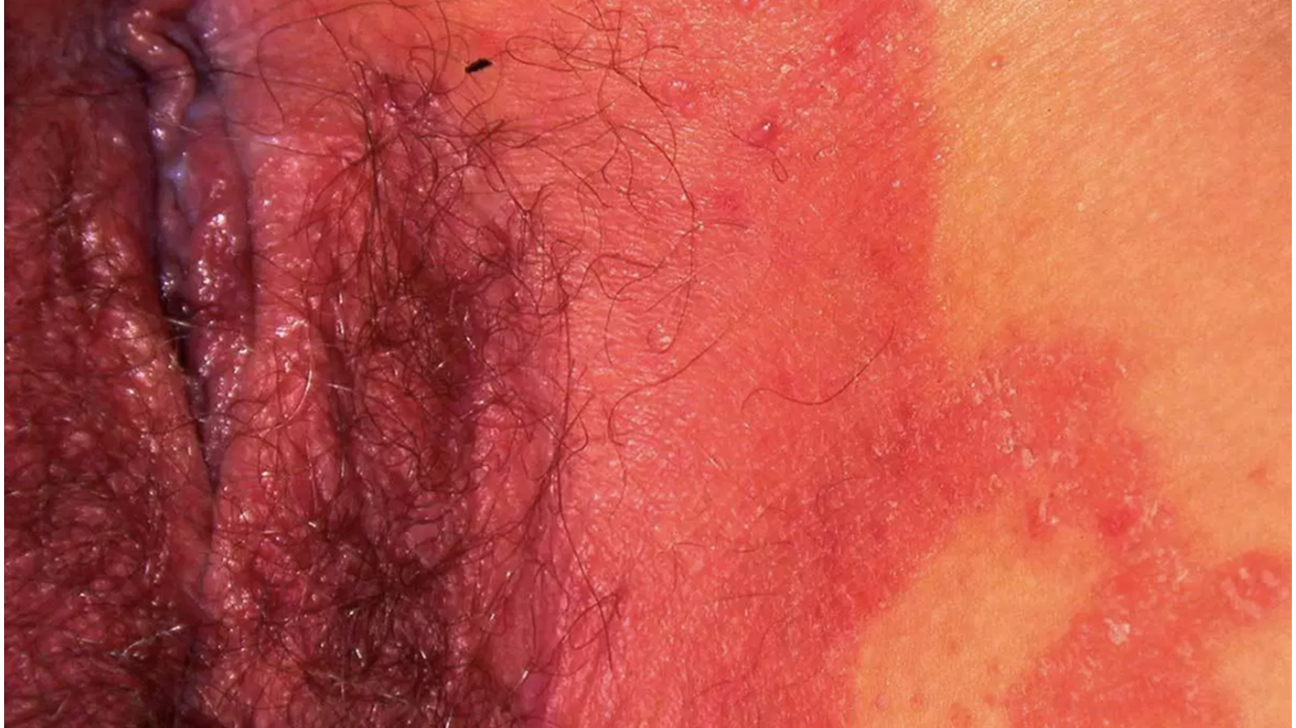 What is this rash on my vulva